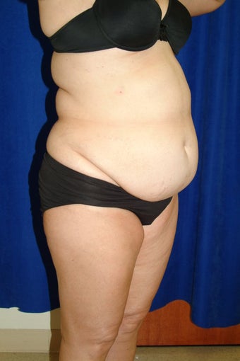Abdominoplasty with liposculpture of abs, flanks, and waist