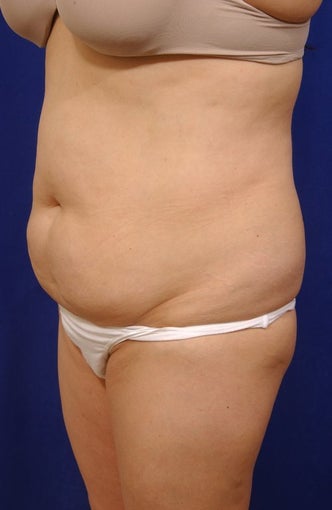 Abdominoplasty with liposculpture of abs, flanks, and waist