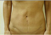 Tummy Tuck