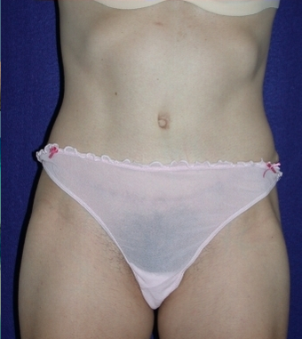Tummy Tuck
