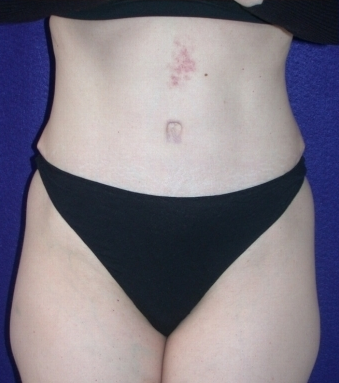 Tummy Tuck (abdominoplasty)