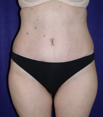 Tummy Tuck (abdominoplasty)