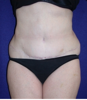 Tummy Tuck (abdominoplasty)