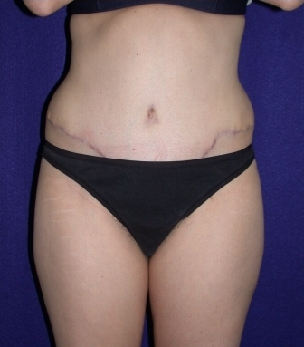 Tummy Tuck (abdominoplasty)