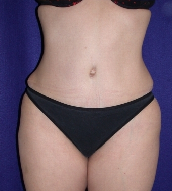 Tummy Tuck (abdominoplasty)