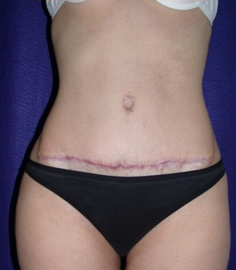 Tummy Tuck (abdominoplasty)