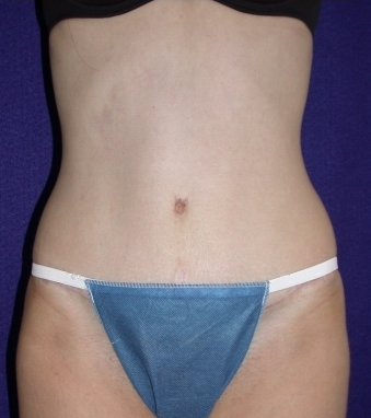 Tummy Tuck (abdominoplasty)