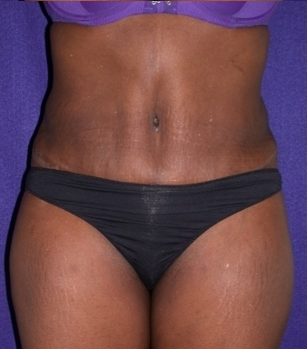 Tummy Tuck (abdominoplasty)