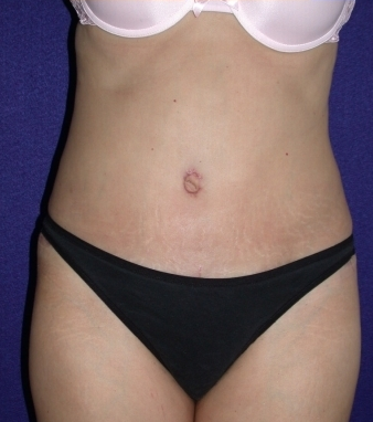 Tummy Tuck (abdominoplasty)