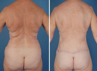 Flank Excision, Abdominoplasty Scar Revision, Liposuction of the Back