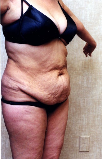 tummy tuck