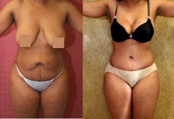 tummy tuck 