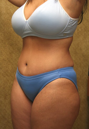 tummy tuck