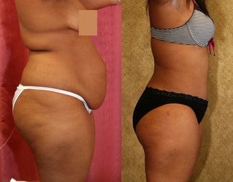 tummy tuck