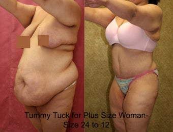 tummy tuck