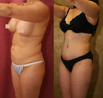 tummy tuck