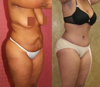 tummy tuck