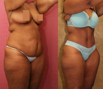 tummy tuck