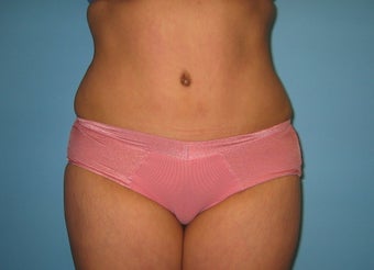 tummy tuck