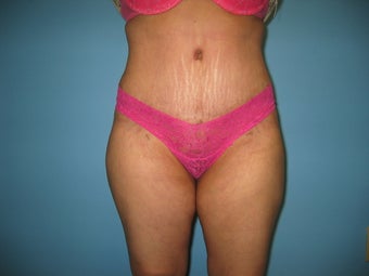 tummy tuck