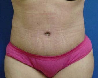 Abdomiplasty (Tummy Tuck)/Liposuction of abdomen, flanks and lateral chest areas