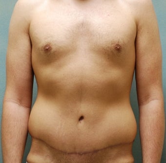 Abdominoplasty