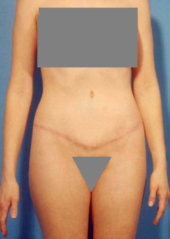 Abdominoplasty