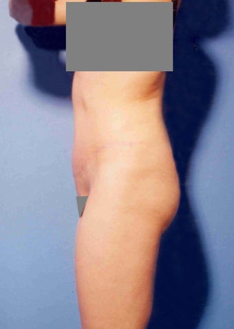 Abdominoplasty