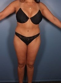 Tummy Tuck