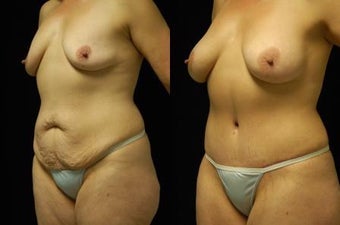 Tummy Tuck and Breast Augmentation, gel implants