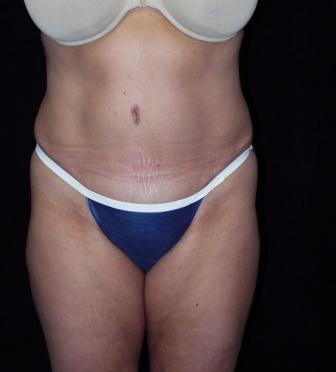 Tummy Tuck with muscle repair