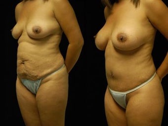 Tummy Tuck and Breast Augmentation