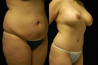 Tummy Tuck and Breast Augmentation- gel implants