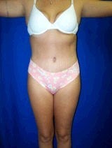 Tummy Tuck (Abdominoplasty)