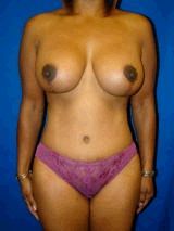 Tummy Tuck (Abdominoplasty), Breast Asymmetry, Breast Lift with Implants