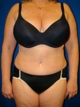 Tummy Tuck (Abdominoplasty)