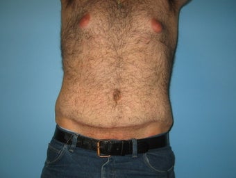 Male tummy tuck