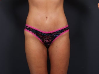 Tummy Tuck