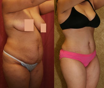 abdominoplasty- tummy tuck