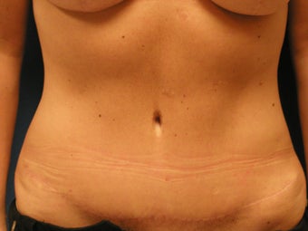 Abdominoplasty