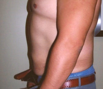 Abdominoplasty (Tummy Tuck)