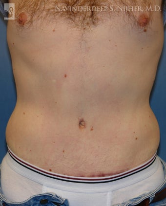 Tummy Tuck