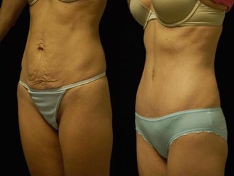 Abdominoplasty
