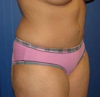 Tummy Tuck
