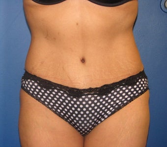 Tummy Tuck
