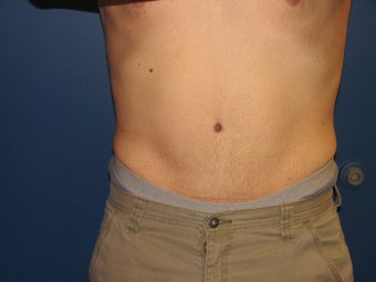 Male Tummy Tuck