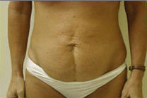 Tummy Tuck