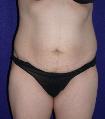 Tummy Tuck