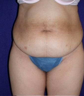 abdominoplasty
