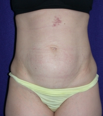 Tummy Tuck (abdominoplasty)